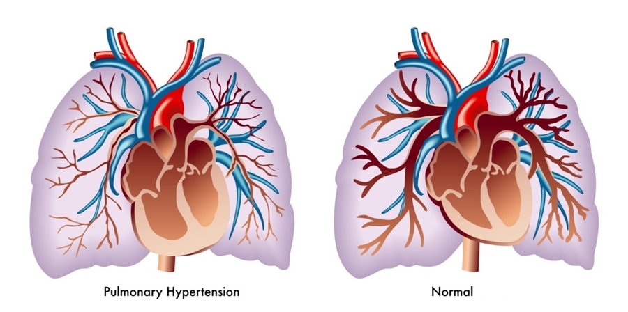 Pulmoner Hipertansiyon Polikliniği (Akciğer Hipertansiyonu)